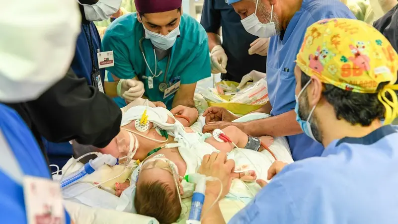 بمشاركة 28 طبيبا وأخصائيا.. نجاح عملية فصل التوأم السيامي اليمني مودة ورحمة